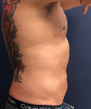 Liposuction Before & After Gallery - Patient 378185 - Image 4