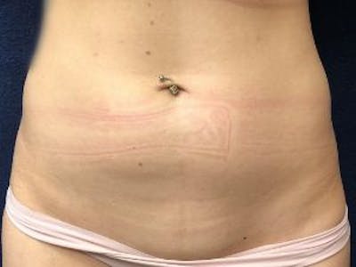 Liposuction Before & After Gallery - Patient 148895 - Image 1