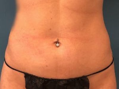 Liposuction Before & After Gallery - Patient 148895 - Image 2