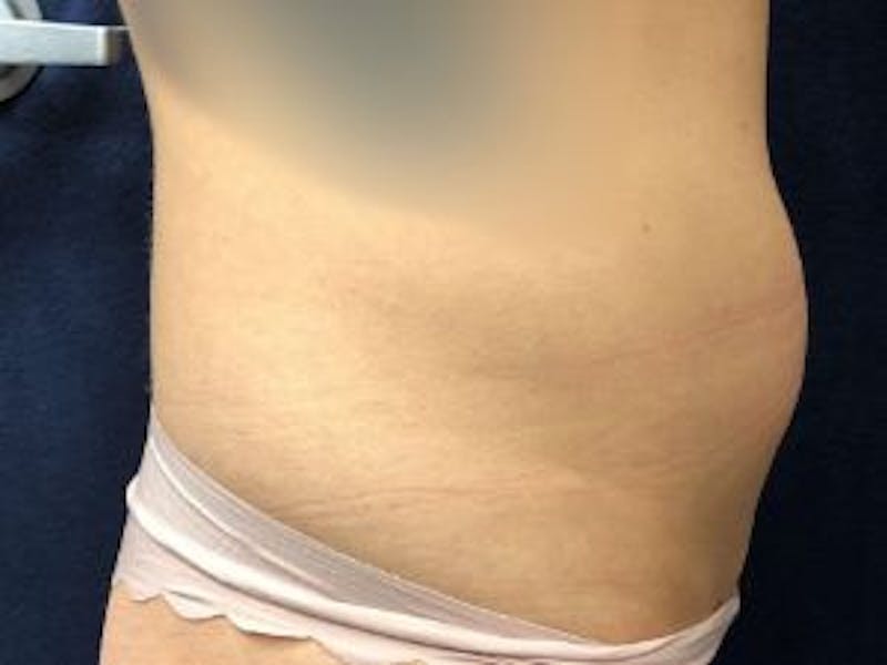 Liposuction Before & After Gallery - Patient 148895 - Image 3
