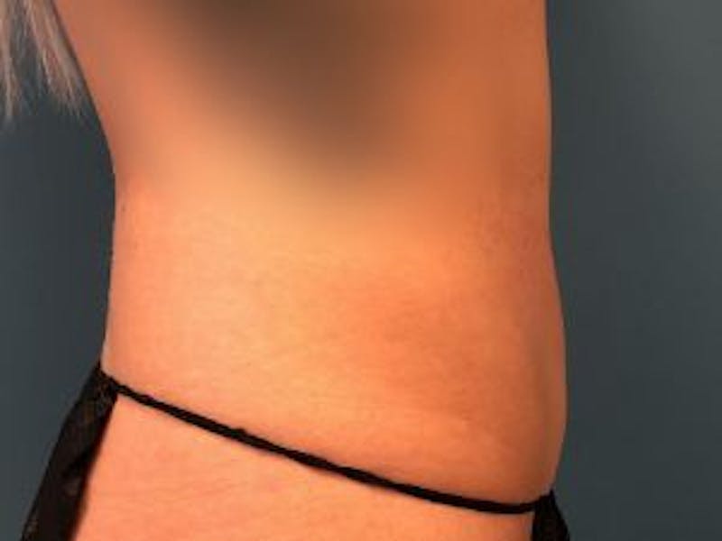 Liposuction Before & After Gallery - Patient 148895 - Image 4