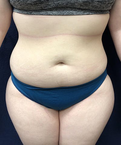 Liposuction Before & After Gallery - Patient 307298 - Image 1