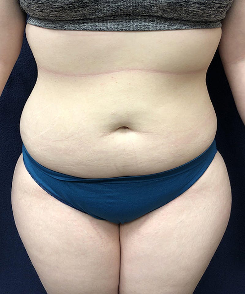 Liposuction Before & After Gallery - Patient 307298 - Image 1