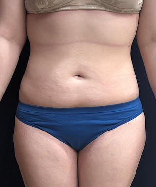 Liposuction Before & After Gallery - Patient 307298 - Image 2
