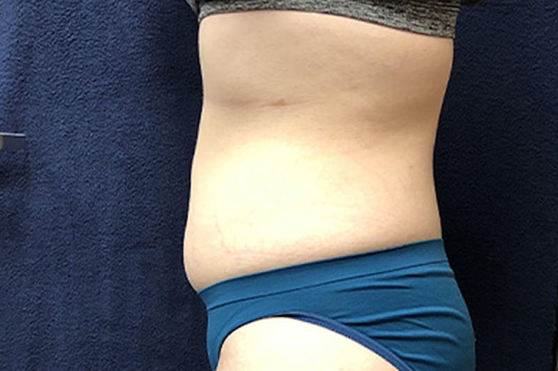 Liposuction Before & After Gallery - Patient 307298 - Image 3