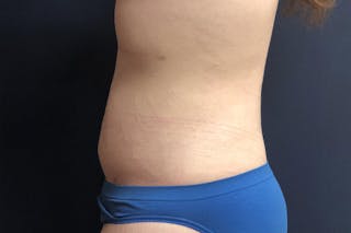 Liposuction Before & After Gallery - Patient 307298 - Image 4