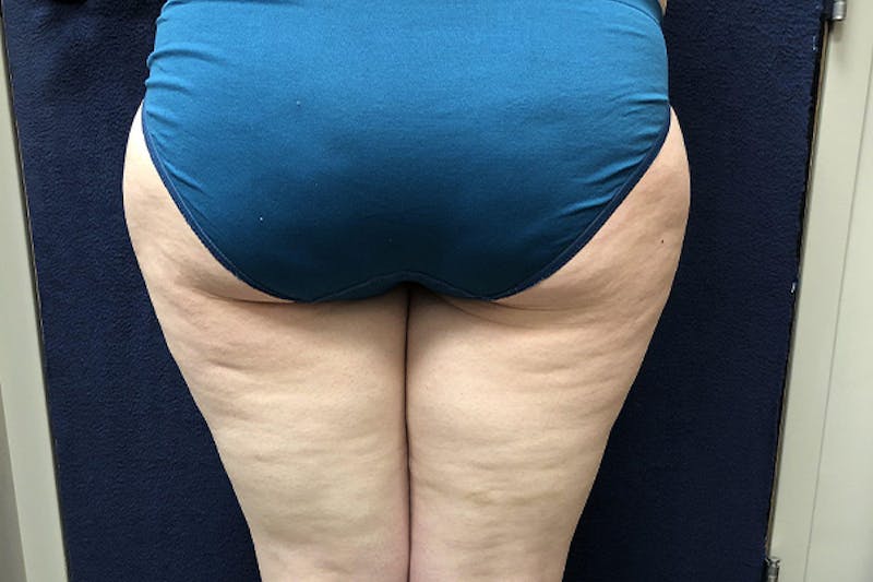 Liposuction Before & After Gallery - Patient 307298 - Image 5