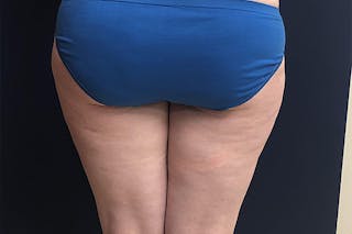 Liposuction Before & After Gallery - Patient 307298 - Image 6