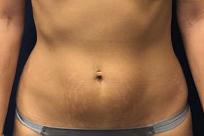 Liposuction Before & After Gallery - Patient 320141 - Image 1