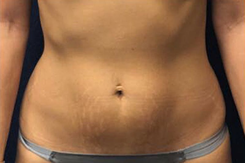 Liposuction Before & After Gallery - Patient 320141 - Image 1
