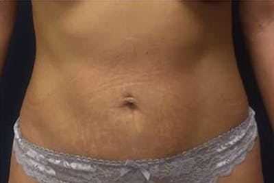 Liposuction Before & After Gallery - Patient 320141 - Image 2