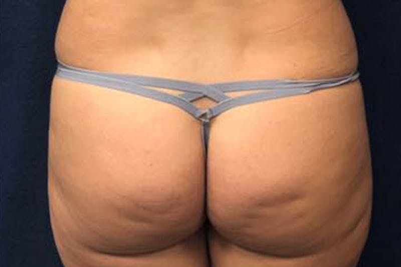 Liposuction Before & After Gallery - Patient 320141 - Image 3