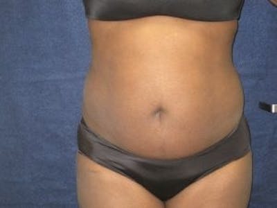 Liposuction Before & After Gallery - Patient 103145 - Image 1