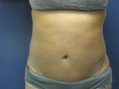 Liposuction Before & After Gallery - Patient 103145 - Image 2