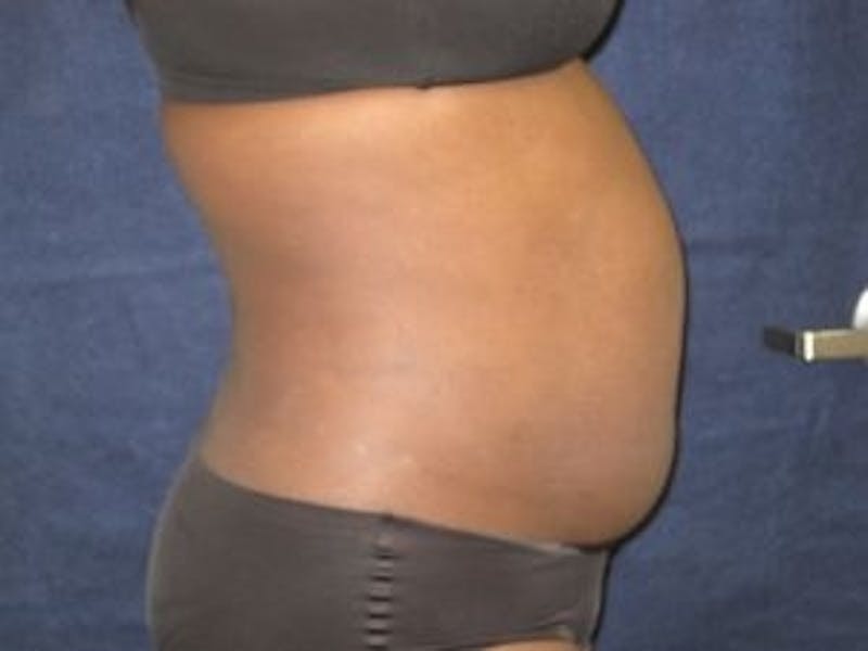 Liposuction Before & After Gallery - Patient 103145 - Image 3