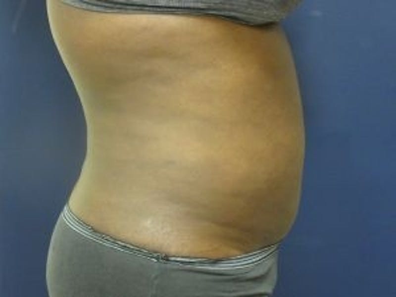 Liposuction Before & After Gallery - Patient 103145 - Image 4