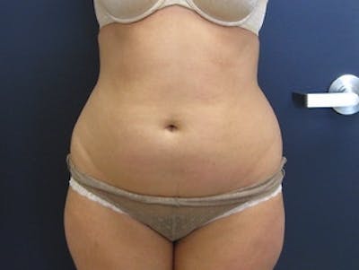 Liposuction Before & After Gallery - Patient 174695 - Image 1