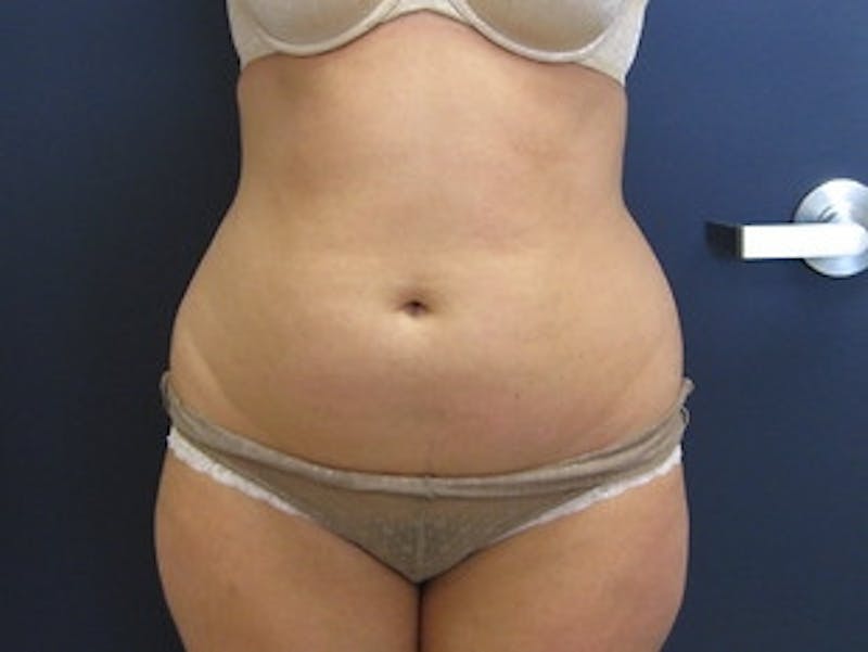 Liposuction Before & After Gallery - Patient 174695 - Image 1