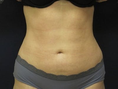 Liposuction Before & After Gallery - Patient 174695 - Image 2