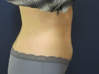 Liposuction Before & After Gallery - Patient 174695 - Image 4