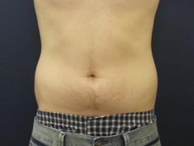 Liposuction Before & After Gallery - Patient 195279 - Image 1
