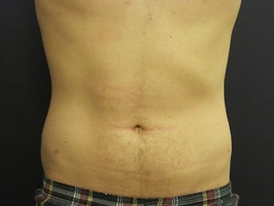 Liposuction Before & After Gallery - Patient 195279 - Image 2