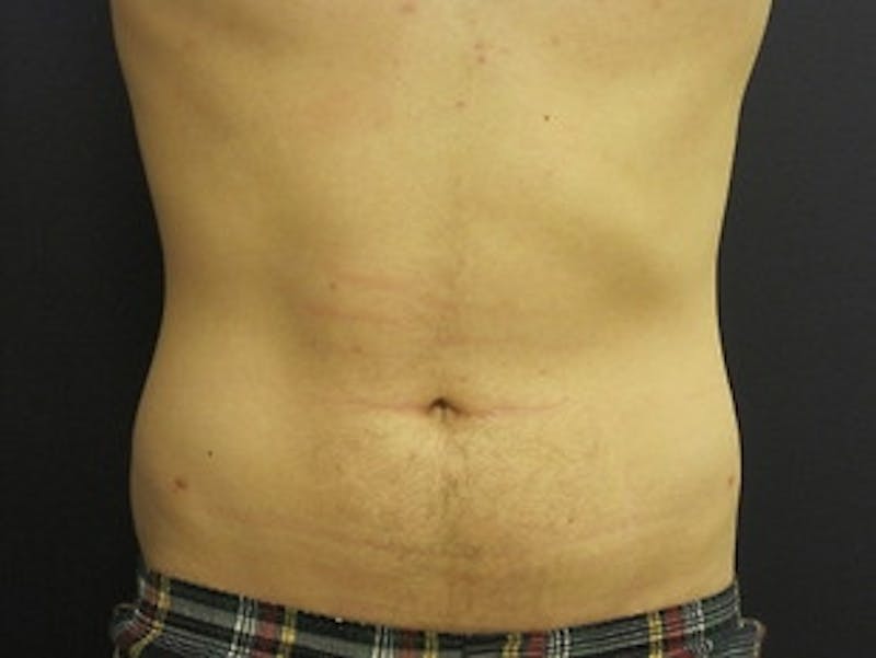 Liposuction Before & After Gallery - Patient 195279 - Image 2