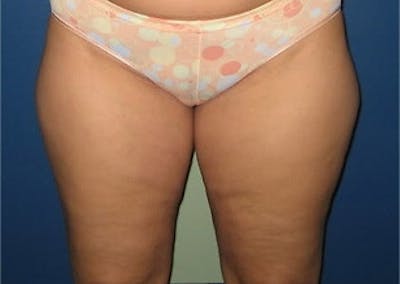 Liposuction Before & After Gallery - Patient 115562 - Image 1
