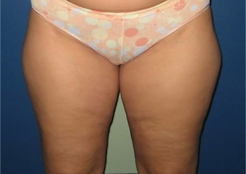 Liposuction Before & After Gallery - Patient 115562 - Image 1