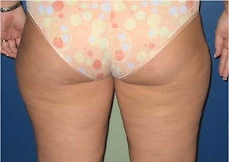 Liposuction Before & After Gallery - Patient 115562 - Image 3
