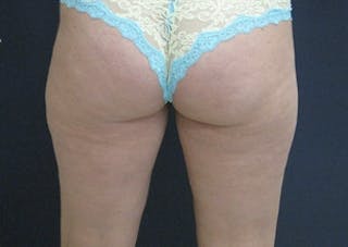 Liposuction Before & After Gallery - Patient 115562 - Image 4