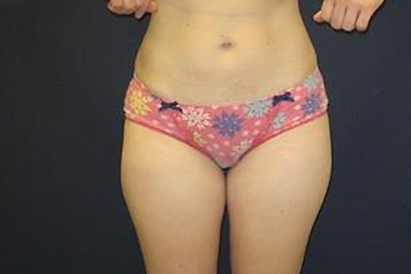 Liposuction Before & After Gallery - Patient 231779 - Image 1
