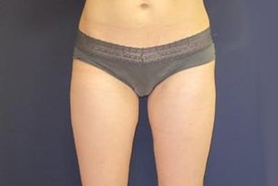Liposuction Before & After Gallery - Patient 231779 - Image 2