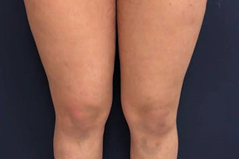 Liposuction Before & After Gallery - Patient 273866 - Image 1