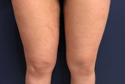 Liposuction Before & After Gallery - Patient 273866 - Image 2