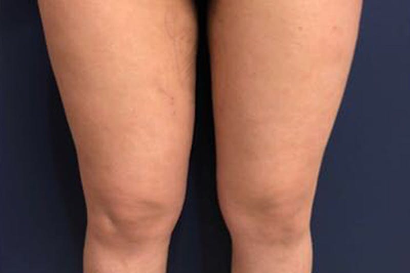 Liposuction Before & After Gallery - Patient 273866 - Image 2