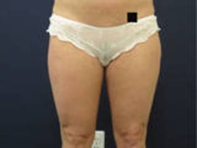 Liposuction Before & After Gallery - Patient 326738 - Image 1