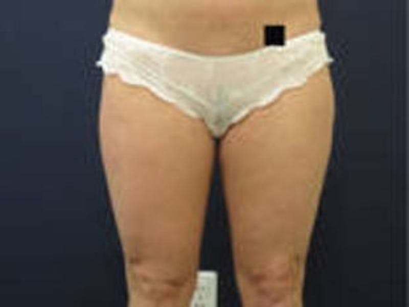 Liposuction Before & After Gallery - Patient 326738 - Image 1