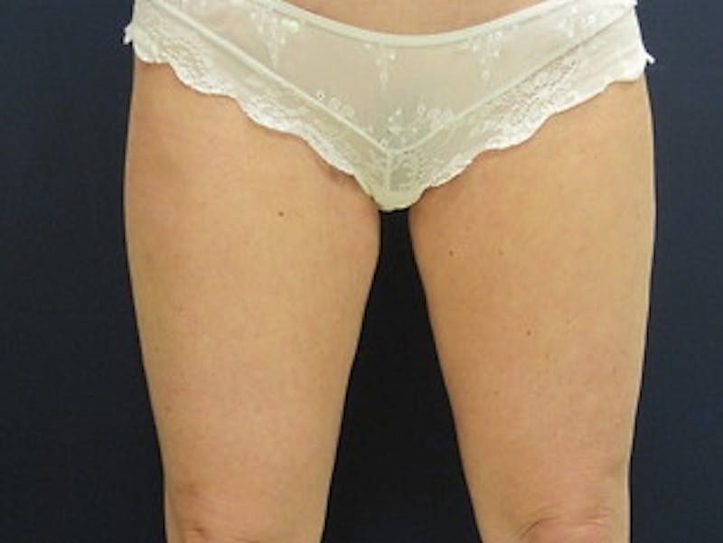 Liposuction Before & After Gallery - Patient 326738 - Image 2