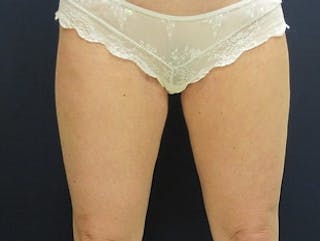 Liposuction Before & After Gallery - Patient 326738 - Image 2