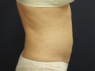 Liposuction Before & After Gallery - Patient 326738 - Image 4