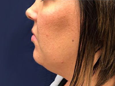 Liposuction Before & After Gallery - Patient 128460 - Image 1