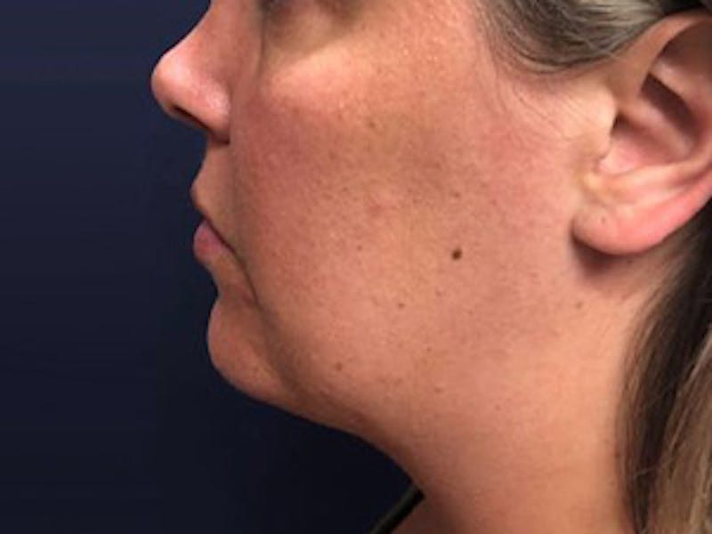 Liposuction Before & After Gallery - Patient 128460 - Image 2