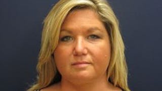 Liposuction Before & After Gallery - Patient 408728 - Image 2