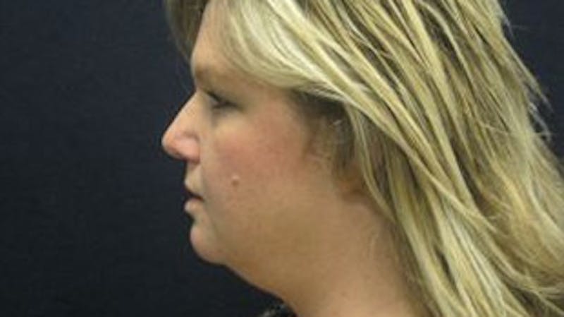 Liposuction Before & After Gallery - Patient 408728 - Image 3