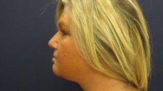 Liposuction Before & After Gallery - Patient 408728 - Image 4