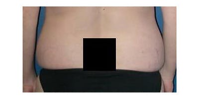 Liposuction Before & After Gallery - Patient 232636 - Image 1