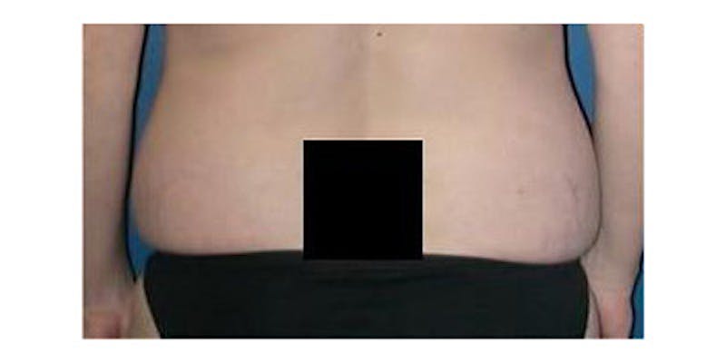Liposuction Before & After Gallery - Patient 232636 - Image 1