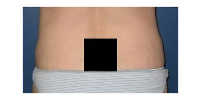 Liposuction Before & After Gallery - Patient 232636 - Image 2