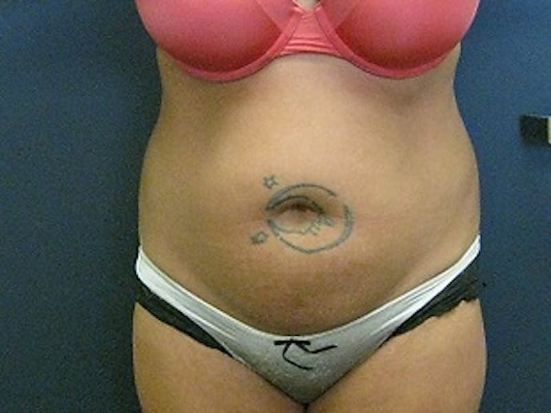 Liposuction Before & After Gallery - Patient 346861 - Image 1
